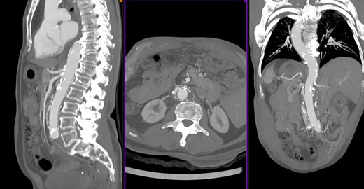 Postoperative angio-CT scan.