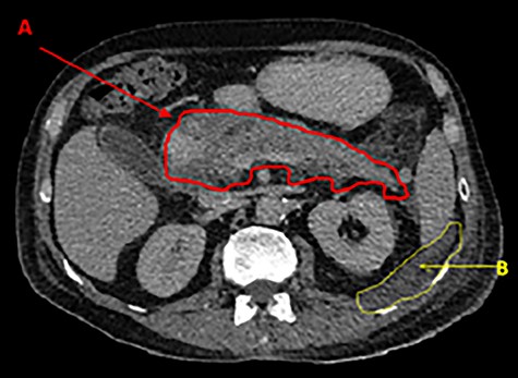 Contrast CT showing inflamed, enhancing pancreas (A) and the presence of paranephric fluid in the retroperitoneal region (B).