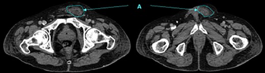 Contrast CT showing fluid tracking anteriorly into the left inguinal region (A).