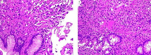 gastric (A) and colonic (B) polyps show neoplastic cells in lamina propria with normal mucosa (H/E stain ×200).