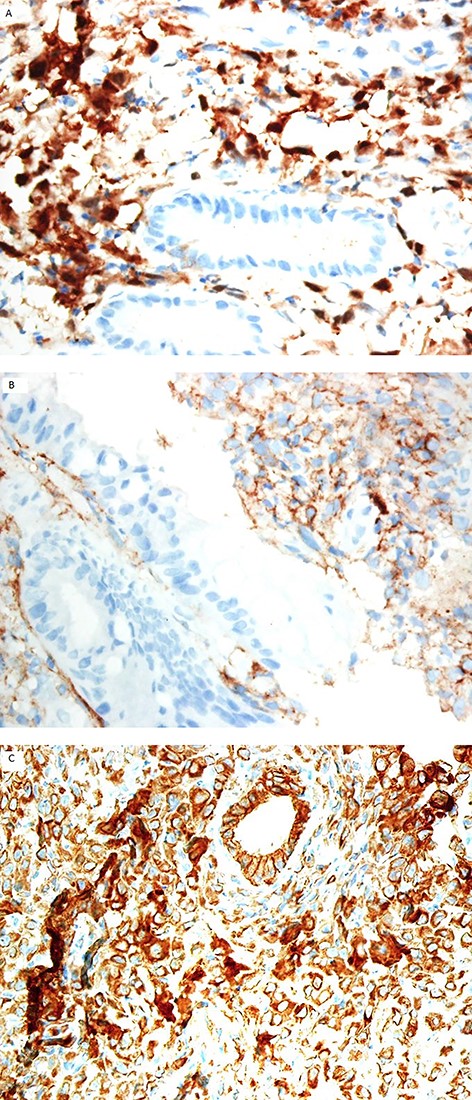 The neoplastic cells are positive for calretinin (A), and D2–40 (B) immunostain. Cytokeratin is positive in the neoplastic cells and background non-neoplastic mucosa (C); (immunohistochemistry stain ×200).