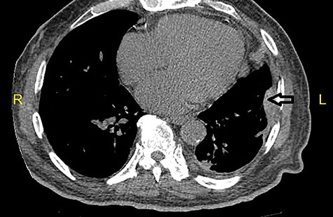 CT scan of the chest reveals nodular thickening (arrow) of left pleura.