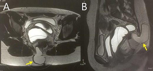 (A and B) MRI shows a large collection in the rectosacrococcygeal region, extending anteriorly to the retrorectal space.