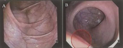 (A and B) Colonoscopy shows extrinsic compression on the rectum.