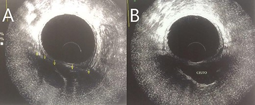 (A and B) Rectal ultrasonography showing a multicystic image.