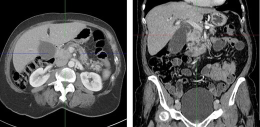 CT scan with a poorly defined 2.5 cm hypodense mass in the pancreatic head causing obstruction of the common bile duct and pancreatic duct. Axial and coronal plane.