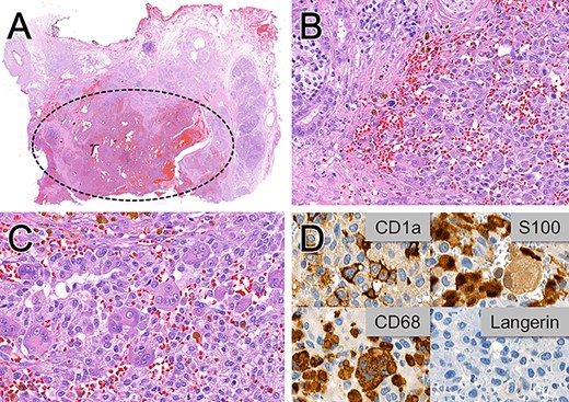 Histopathological (A–C) and immunohistochemical (D) examinations of the pancreaticoduodenectomy specimen. (A) Hemorrhagic, poorly circumscribed proliferation. (B) Medium-sized ovoid cells with variable amounts of granular cytoplasm, indistinct cell boundaries and elongated nuclei with inconspicuous nucleoli infiltrating into the adjacent pancreatic parenchyma. (C) Focal giant cell formation. (D) Variable positivity for the dendritic cell markers CD1a, S100 and CD68 and no immunoreactivity for Langerin. Magnification x6 in A, x300 in B, x400 in C and D.