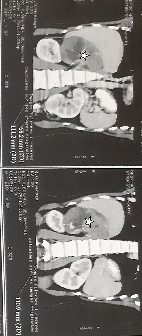 Abdominal CT scan showed a 12.5 × 9 × 7.5 cm tissular heterogeneous mass, with irregular borders, located in the right adrenal gland (white star).