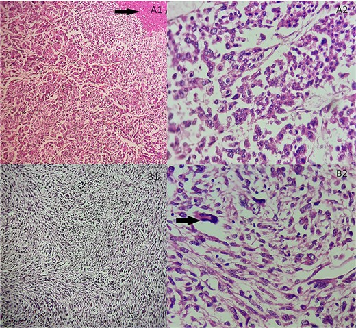 (A) Adrenocortical sarcomatoid carcinoma histological features Carcinomatous component showing sheets and nests of epithelioid cells and necrosis (black arrow). (A1) Hematoxylin and eosin, ×100. (A2) Hematoxylin and eosin, ×400. (B) Adrenocortical sarcomatoid carcinoma histological features: sarcomatous component consisted of spindle-shaped and ovoid cells arranged in fascicular pattern. Associated to some multinucleated neoplastic giant cells (black arrow). (B1) Hematoxylin and eosin, ×200. (B2) Hematoxylin and eosin, ×400.