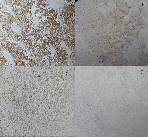 Adrenocortical carcinosarcoma immunohistochemistry: The carcinomatous areas are synaptophysin positive (A); Melan-A positive (B); PS100 positive (C) and SMA negative (D) (Immunohistochemical stain, ×200).