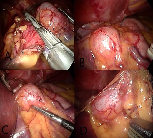 (A and B) A view showing GDCs, a regular shape with clear edges positioned on the front surface and the small curvature of the stomach. (C) We note the maintainance of the shape and size after its compression and try to get it with surgical instruments. (D) After open the small omentum where the posterior surface is observed to GDCs with a number of adjacent lymph nodes.