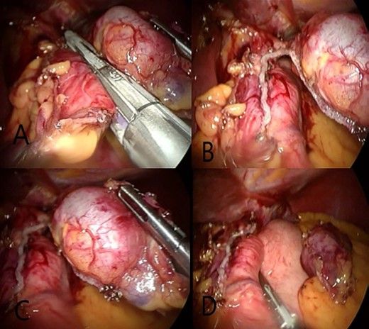 (A) Eradicate GDCs by laparoscopic surgery using endo-GIA special for these cases. (B and C) Separate the GDCs from the stomach while keeping a part connected to the stomach. (D) Complete LSG.
