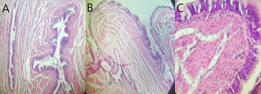 Histological overview using hematoxylin and eosin (H&E) staining demonstrated the cystic wall lined with gastric foveolar epithelium surrounded by a smooth muscle layer with a pseudostratified ciliated epithelial content without cytologic atypia. (A, H&E X 100; B, H&E X 200; C, H&E X 400).