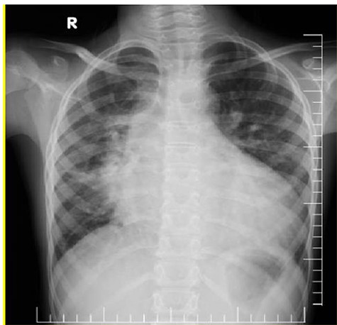 (A) Chest X-ray showed prominent pulmonary vascular marking, atelectasis in the right lung and cardiomegaly with a widening mediastinum. (B and C) Echocardiography: short-axis view revealed VSD (B) and long-axis view showed ascending aortic aneurysm (C).