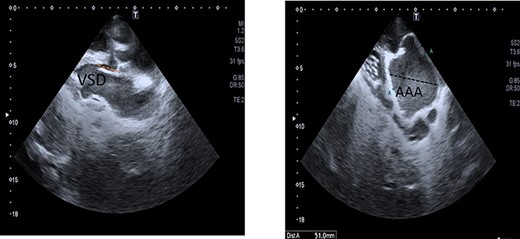 Contrast thoracic CT showed the left main pulmonary artery (A: red arrow) and right main pulmonary artery (B: red arrow) originate from a single truncus. It was evaluated as compatible with the TA and combined with ascending aortic aneurysm (A and B: red arrows).