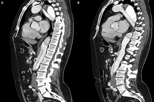 (A) Coronal section demonstrating the distal arch with the left vertebral and subclavian arteries visible; (B) coronal section demonstrating aneurysmal enlargement of the descending thoracic aorta and Type B dissection.