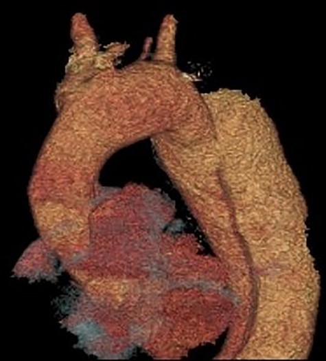 3D reconstruction of the CT scan demonstrating the four-vessel arch configuration with the aberrant left vertebral artery located in the Zone 2 region.