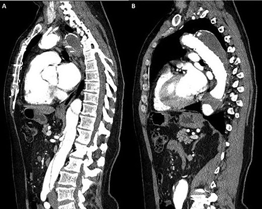Coronal section CT scan images demonstrating the newly arranged epiaortic reconfiguration on left (A) and on the right (B) the deployed FET and antegrade flow in the descending thoracic aorta through the true lumen.
