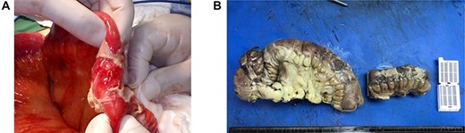 (A) Fibrinopurulent exudate and terminal ileal perforation at 20 cm from the ileocecal valve, measuring 0.3 cm in diameter. Pre-perforated areas are located at 40 and 60 cm from the ileocecal valve. (B) Resection of the ileum.