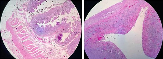 Acute ulcerative ileitis with perforation.