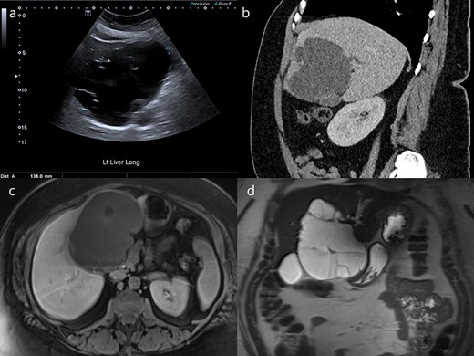 Ultrasound, CT and MRI imaging of the cyst. (a) Ultrasound detected a septated cyst measuring up to 140 mm in diameter. (b) Intrahepatic bile duct dilatation was demonstrated on CT (sagittal). The cyst was (c) hypointense on T1-weighted images (axial) and (d) hyperintense on T2-weighted images (coronal).