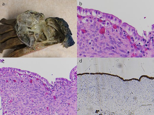 Macroscopic and microscopic features of the cyst. (a) There was a trabeculated and loculated cavity within the left lobe. (b) The cyst was lined by a single layer of columnar mucinous epithelium without cytological atypia (H&E staining, ×200). (c) This epithelium was underlined by an ovarian-like hypercellular stroma (H&E staining, ×100), and (d) was positive for cytokeratin 7 (CK7 staining, ×40).