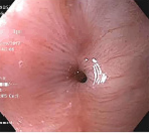 Stricture of the esophagogastric anastomosis.