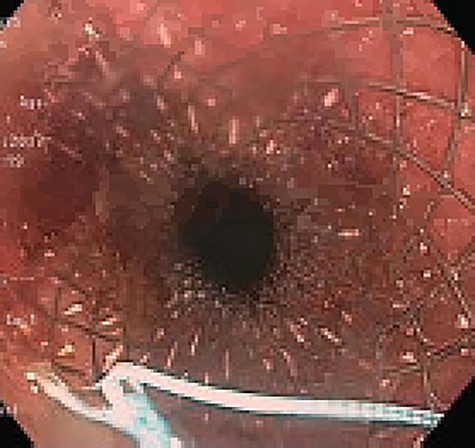 SEMS placement across esophagogastric anastomosis.