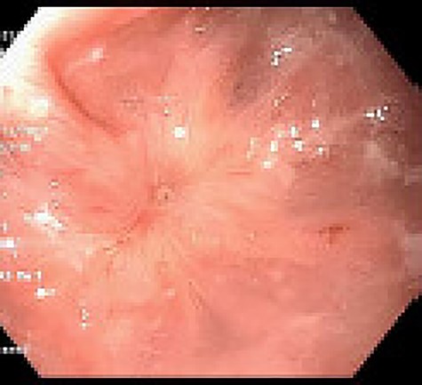 Web with near complete luminal obstruction.