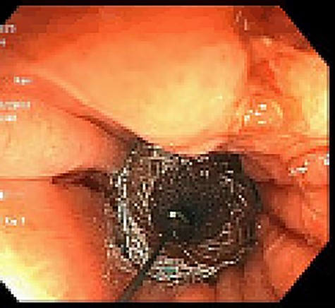 Retrograde guidewire, with subsequent pediatric colonoscope and SEMS placement.