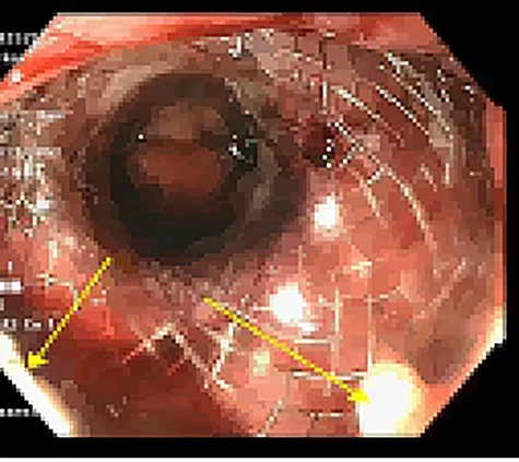 SEMS placement across web, secured with 2-0 polypropylene suture via Overstitch device.