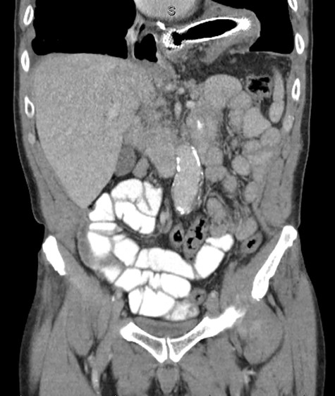 Coronal CT identifying SEMS within the transverse colon, herniated into the thoracic cavity.
