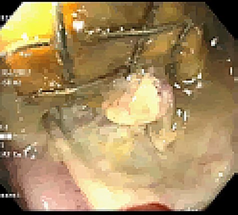 Colonoscopic identification of SEMS within the transverse colon.
