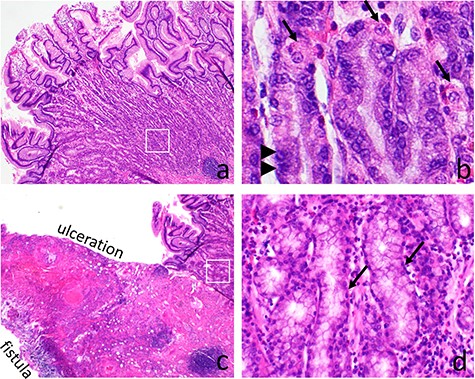 Gastric heterotopia (GH) causing bowel perforation. The GH shows full thickness of gastric fundic type mucosa with surface foveolar epithelium and deep fundic glandes (a). The fundic glands have specialized parietal cells (arrows) and chief cells (arrow heads) (b). At the center of the GH, mucosal ulceration with transmural inflammation and fistula formation are present (c). Adjacent to the ulcerative area, the mucosa transits into antral/pyloric type with only mucinous epithelium present in the deep glands (d)