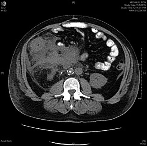 CT abdomen and pelvis with oral contrast at the level of L2 showing marked inflammatory changes surrounding the ascending colon and obscuring the colonic margins. Phlegmonous changes are seen extending to the root of the mesentery, in the left perinephric space and inferiorly into the pelvis. Infrarenal IVC filter and right ureteral stent are in place.
