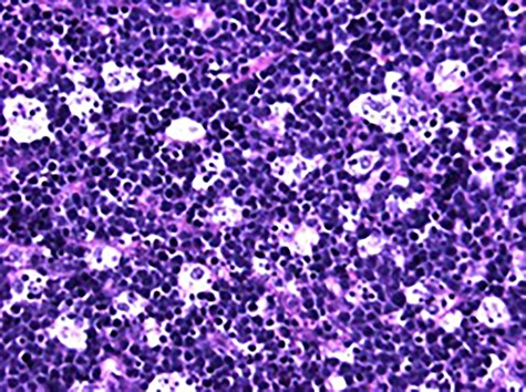 High power photomicrograph (40×) of H&E stained tumor sample showing diffuse lymphoid infiltrate with numerous mitotic figures and apoptotic cells creating the classic ‘starry sky’ appearance of BL.