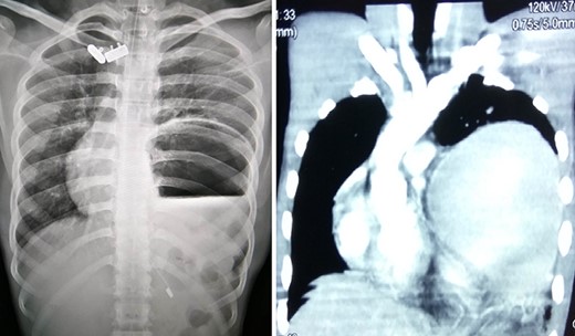 Chest X-ray and CT showing an elevated left hemi-diaphragm with a large sub-diaphragmatic air-fluid level.