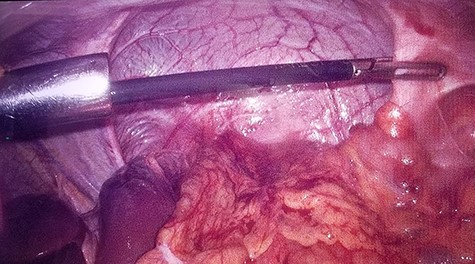 Intraoperative laparoscopic view of left diaphragmatic eventration.