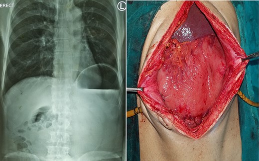 Chronic gastric volvulus, showing raised left hemi-diaphragm in chest X-ray, with intraoperative placement of double gastrostomy tube for fixation.