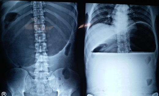 X-ray showing a markedly distended and spherical stomach suggesting gastric volvulus.