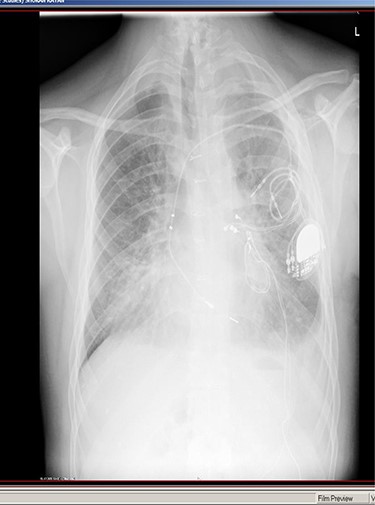 Chest X-ray on admission.
