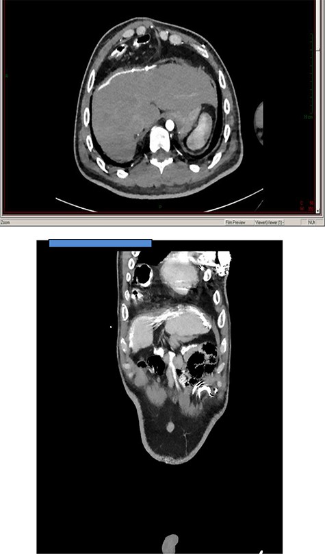 Axial and coronal thoracoabdominal CT showing transthoracic displacement of a segment of colon covered by the old mesh implant.