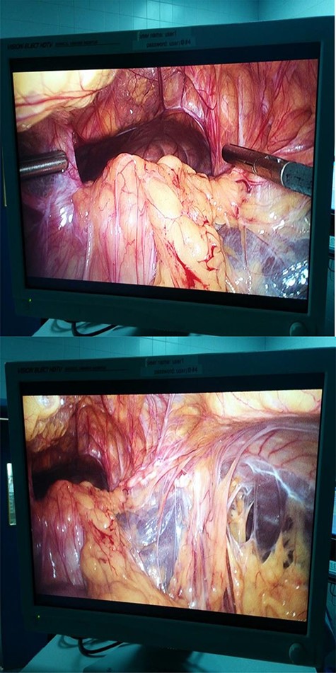 Laparoscopic views of the defect and attendant omental adhesions.