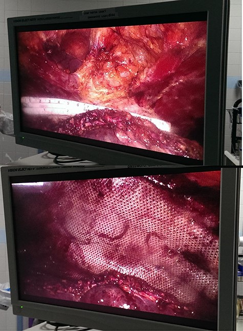 Ruler measurement (top image) and mesh overlap onlay (bottom image).