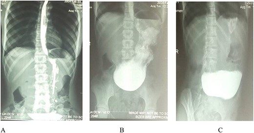 Barium meal: (A and B) Erect anteroposterior view show prolongation of stomach to suprapubic region. B and C (oblique view): Show gastric distension, no passage of contrast medium into the duodenum and delayed gastric emptying (C).