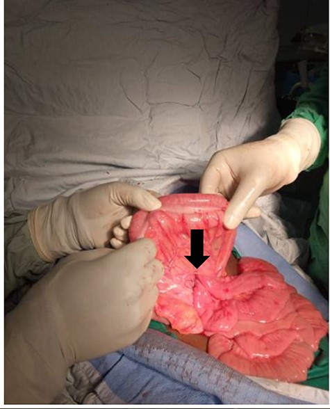 Omega transmesocolic gastrojejunal anastomosis.