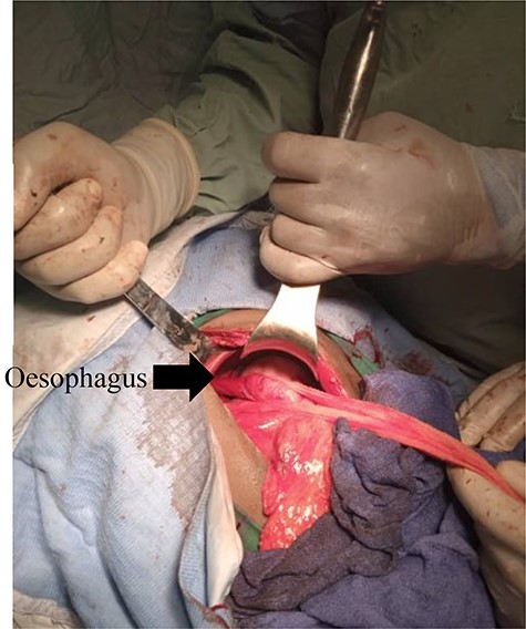 Draschsted’s bilateral troncular vagotomy completed by Toupet’s posterior hemivalve.