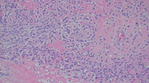 Histopathology of urinary bladder tumor showing oval- to spindle-shaped cells with abundant osteoid matrix deposition (H&E stain, ×200).