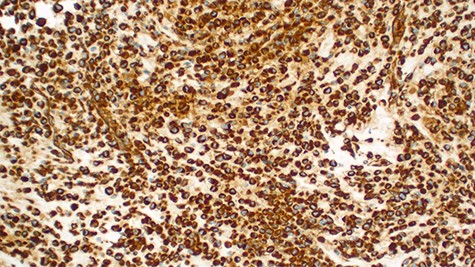 Strongly positive for vimentin immunohistochemistry staining of the tumor cells (×100).