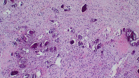 Calcified schistosomal ova near or within the tumor (H&E ×400).